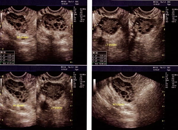 POLYCYSTIC OVARY SYNDROME (PCOS)